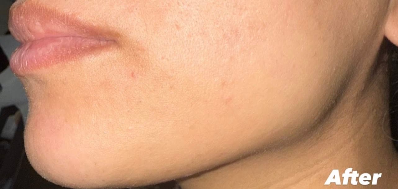 Comparison of a client's lower face before and after a course of laser hair removal