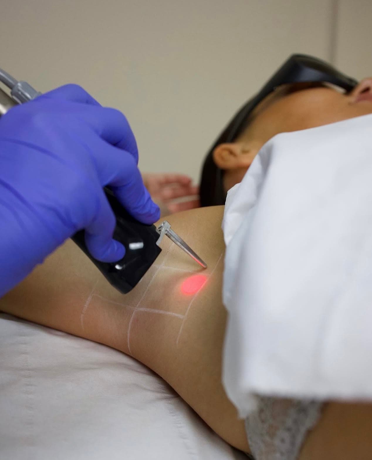 An underarm laser session, the treatment area mapped in white pencil